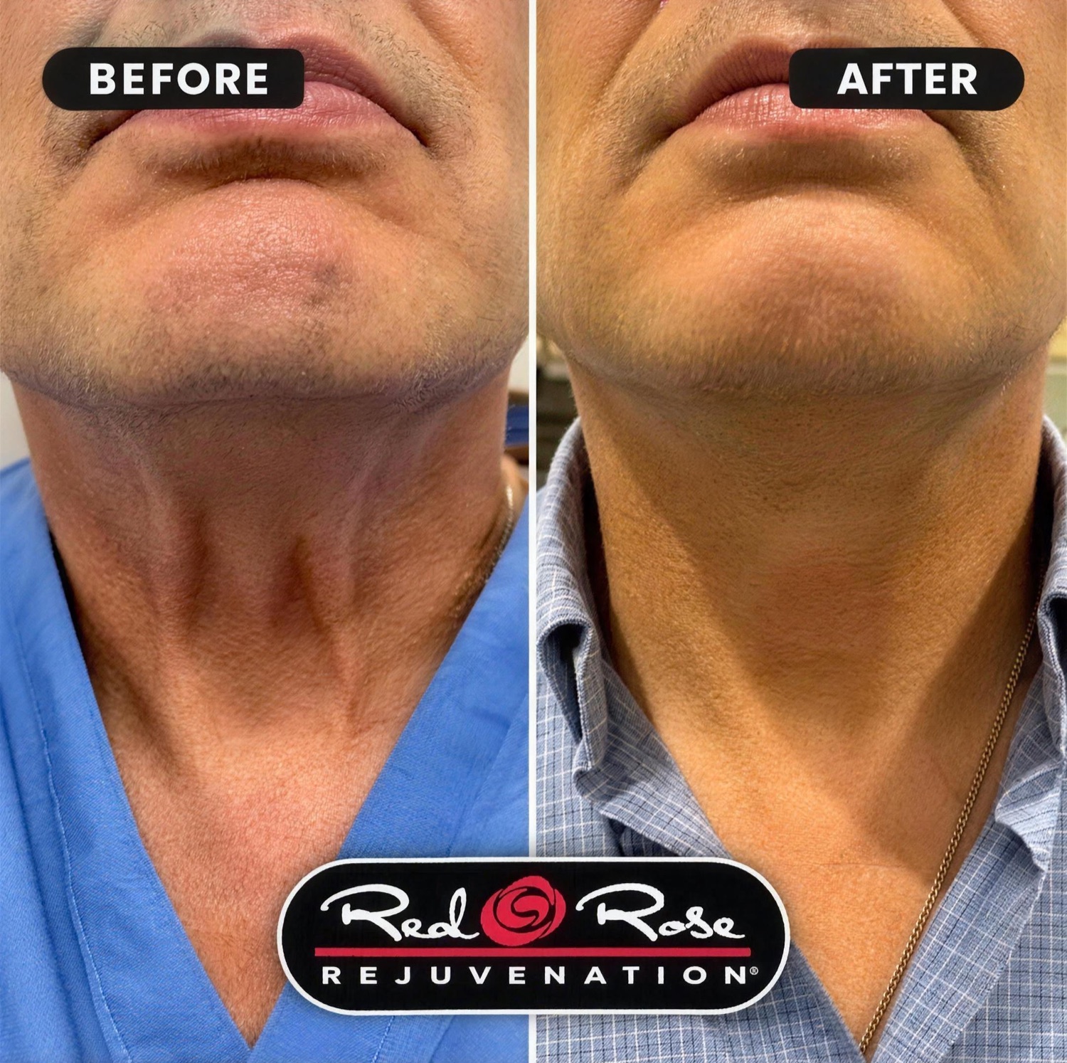 Before and after neck rejuvenation: smoother, firmer skin on the neck and jawline